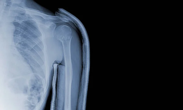 Röntgenképek Lapocka Alatti Vállízületről Hogy Lássák Sérüléseket Csonttöréseket Inakat Orvosi — Stock Fotó