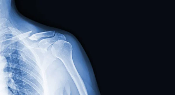 Röntgen Képek Vállízület Hogy Sérülések Kulcscsont Törés Inak Orvosi Diagnózishoz — Stock Fotó