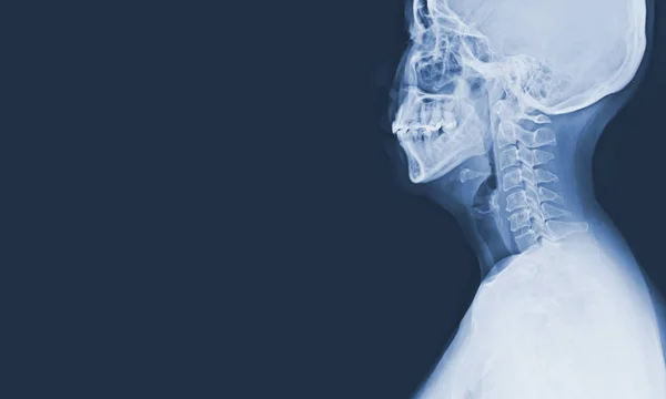 Radiografía Cespina Dorsal Compresión Moderada Médula Espinal Concepto Imagen Médica —  Fotos de Stock
