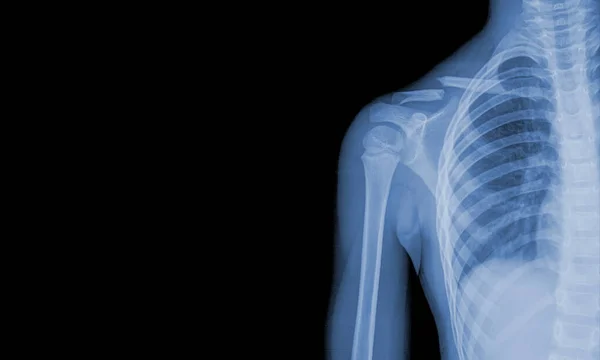 x-ray images of the shoulder joint to see injuries clavicle fracture and tendons for a medical diagnosis.Medical image concept and copy space.