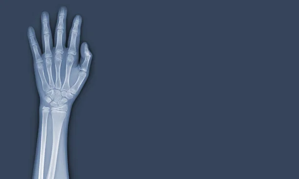 Ray Images Hand Wrist Joint See Injuries Tendons Soft Tissue — Stock Photo, Image