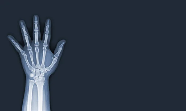 Ray Images Hand Wrist Joint Views See Injuries Tendons Soft — Stock Photo, Image