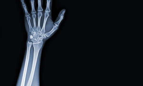 Röntgenfoto Van Hand Polsgewricht Zien Verwondingen Pezen Zachte Weefsel Zwelling — Stockfoto