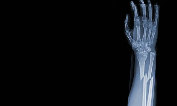 Ray Images Both Hand Wrist Joint Views See Injuries Radius — Stock Photo, Image