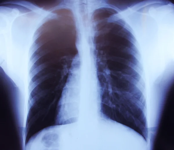 Röntgenbild der Brust eines gesunden Mannes — Stockfoto