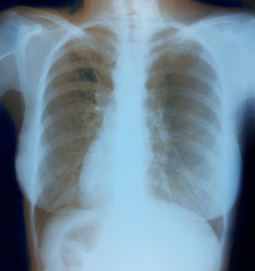 sağlıklı kadın göğüs x-ray görüntüsü