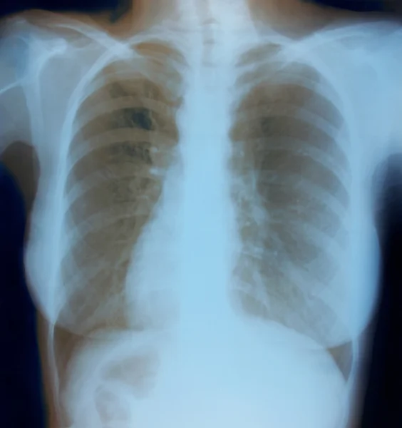 Chest X-ray image of healthy woman — Stock Photo, Image