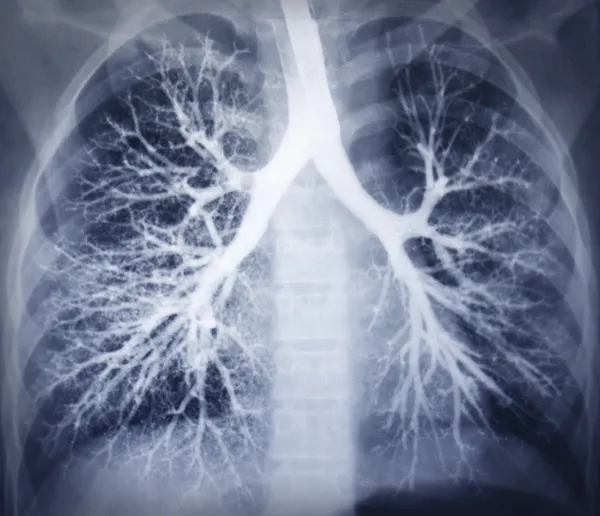 Imagen de broncoscopia. Radiografía de tórax. Pulmones sanos —  Fotos de Stock