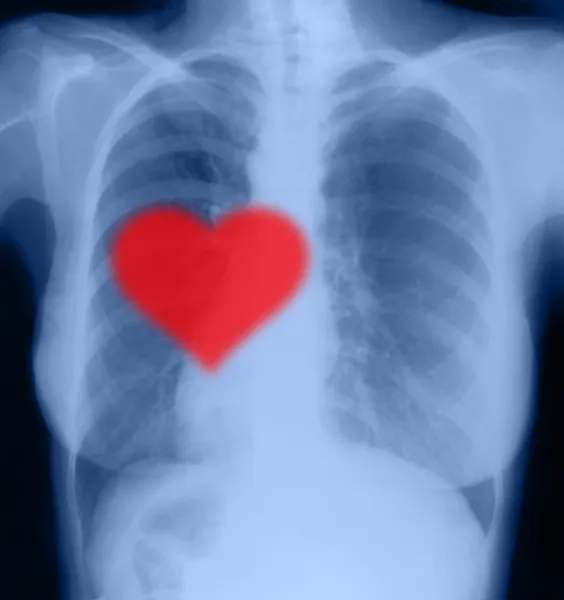 Red heart on x-ray chest — Stock Photo, Image