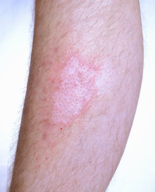 Vitiligo
