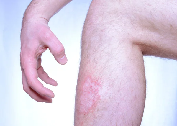 Itchy skin Stock Picture