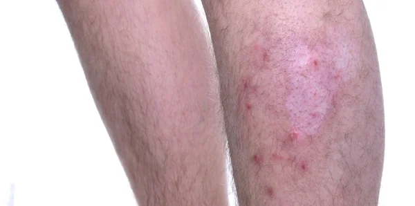 피부 질환 Vitiligo 로열티 프리 스톡 사진