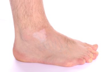 Vitiligo Spot