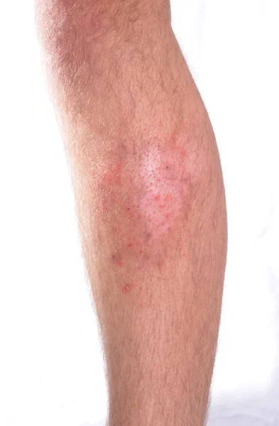 Skin Infection — Stock Photo, Image