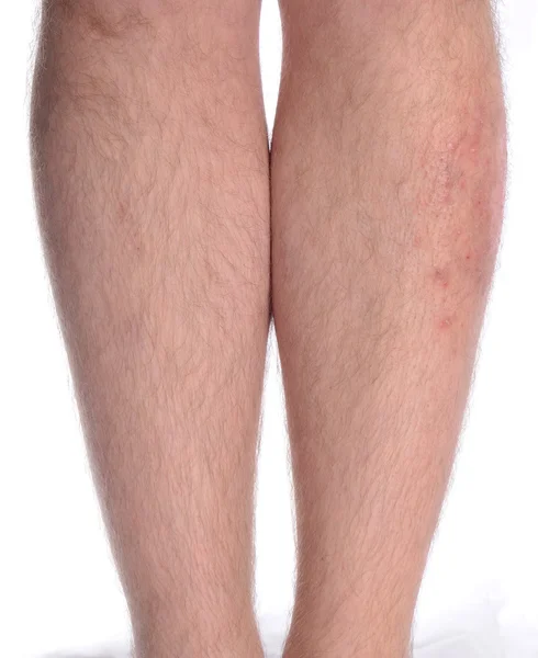 Enfermedad de la piel en la pierna —  Fotos de Stock