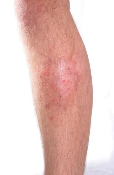 Skin Infection Stock Image