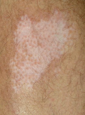 Vitiligo