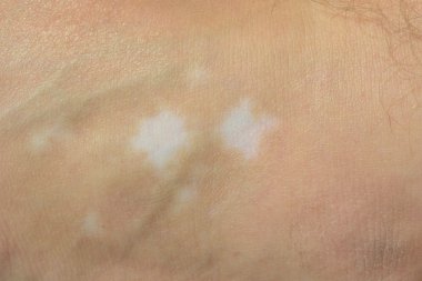 Vitiligo