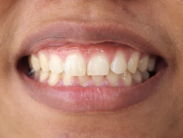 Diastema entre os incisivos superiores é uma característica normal — Fotografia de Stock