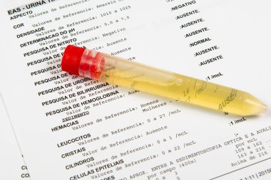 İdrar tahlili yapılan test tüpü, test sonuçları olan bir kağıdın üzerinde.