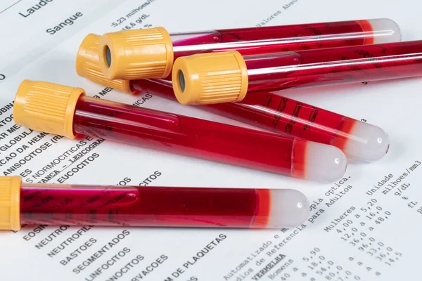 vacuum tube for blood test over clinical analysis result sheet