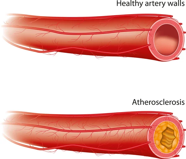 Атеросклероз — стоковый вектор