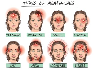 Bazı baş ağrılarının vektör karikatür çizimleri ve baştaki yerlerin ağrının hissedilebileceği yerler..