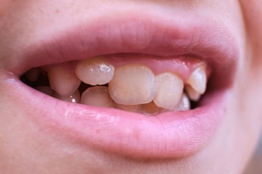 The child is showing his teeth with plaque. Pediatric Dentistry. Dark stains on teeth.
