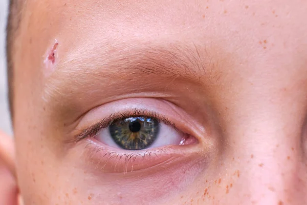 Child Eye Freckles Wound Child Head — Stockfoto