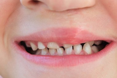 A child shows his crooked teeth. Above the lip is a scar from an operation. Rotated cleft palate pathology