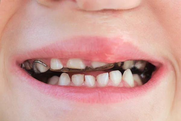 A child shows his crooked teeth. Teeth with removable orthodontic plate