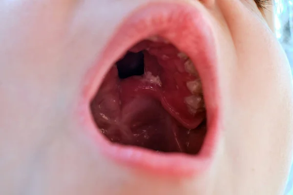 Close Child Mouth Cleft Middle Part Palate Congenital Pathology Стоковое Фото
