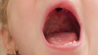 Close-up of a child's mouth. The cleft in the middle part of the palate. Congenital pathology