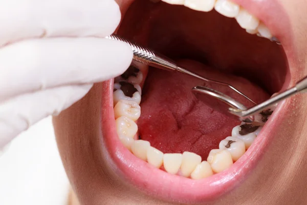 Tandheelkundige behandeling bij de tandarts Stockfoto