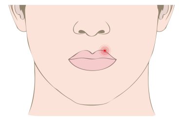 herpes virüsü ağzına