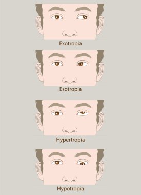 Şaşılık kusur esotropia, exotropia, hypertropia, hypotropia