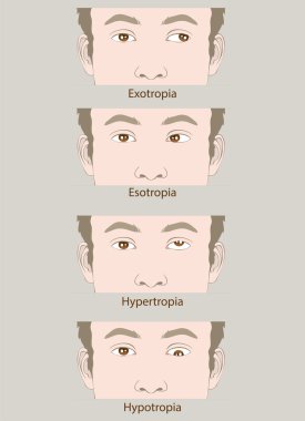 Strabismus defect Esotropia, Exotropia, Hypertropia, Hypotropia clipart