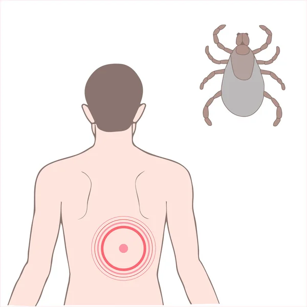 La maladie de Lyme — Image vectorielle