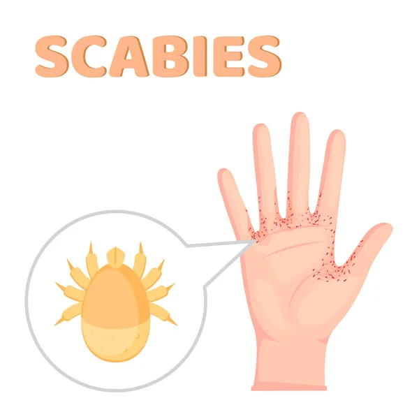 Scabies Contagious Skin Infestation Scabies Mite Humans Skin Magnified View — Stock Vector