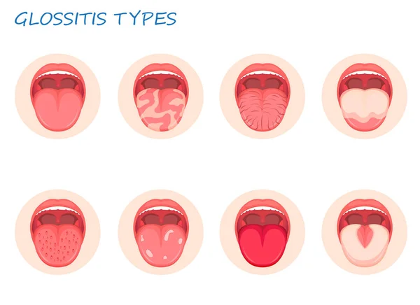 Tipos Glositis Candidiasis Lengua Zorzal Inflamación Lengua Infografías Ilustración Vectorial — Vector de stock