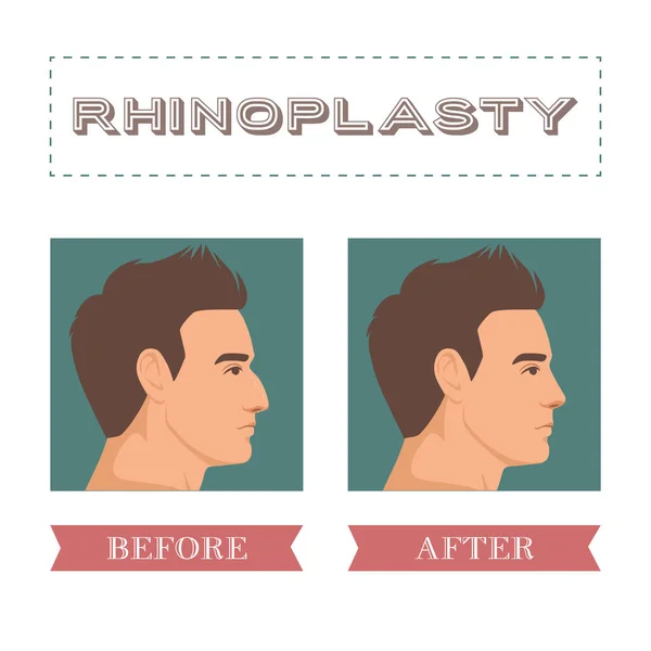 Rhinoplasty Nose Surgery Vector Illustration Surgery Clinic Hospitals Advertisement Body — 스톡 벡터