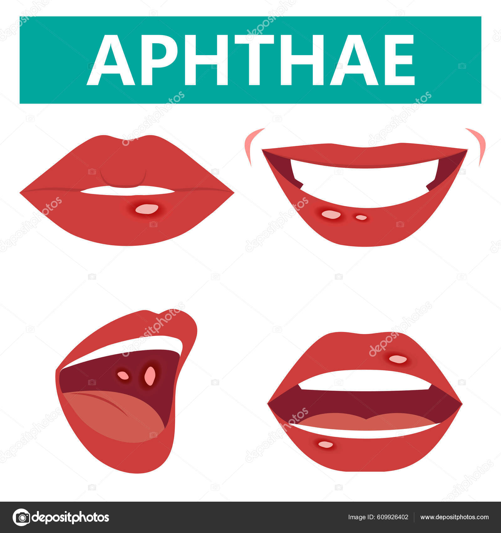 多形性潰瘍は 口の中で再発性の円形または楕円形の痛みや潰瘍であります 多形性口内炎のベクトルイラスト 口腔粘膜のアフター ストックベクター  ©eveleen 609926402, image size:1600x1700