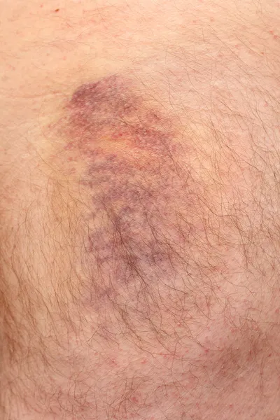 Hematomas — Fotografia de Stock