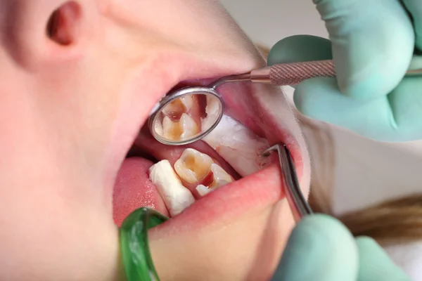 Cavità dentale — Foto Stock