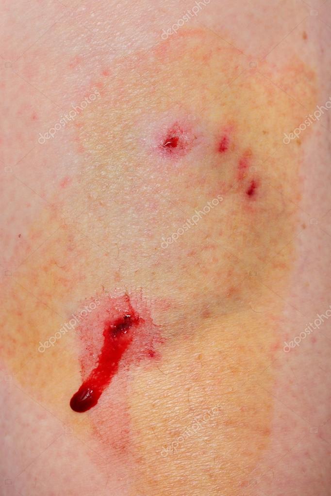 Can You Get Worms From Dog Bite