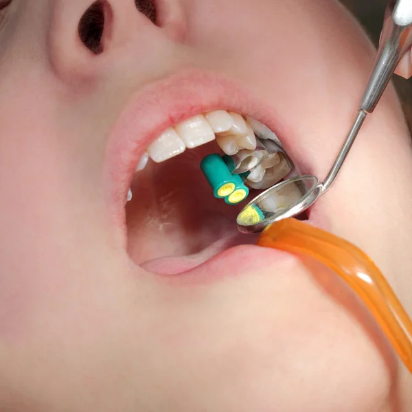 Procedury stomatologiczne, wiercenie ząb — Zdjęcie stockowe