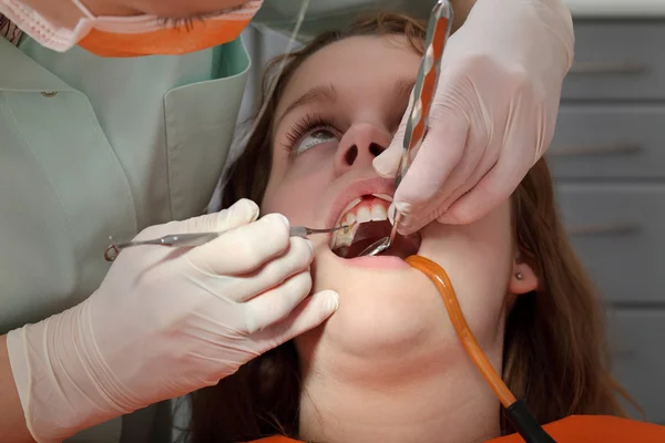 Procedimiento dental, perforación y llenado de dientes — Foto de Stock