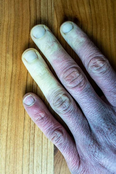 Uma Mão Masculina Congelada Com Síndrome Raynaud Fenômeno Raynaud Doença — Fotografia de Stock