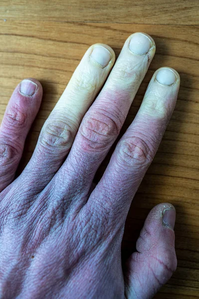 Uma Mão Masculina Congelada Com Síndrome Raynaud Fenômeno Raynaud Doença — Fotografia de Stock