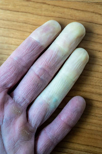 Ένα Ψυχρό Αρσενικό Χέρι Σύνδρομο Raynaud Φαινόμενο Του Raynaud Νόσο — Φωτογραφία Αρχείου